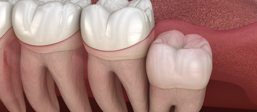 videos of wisdom teeth surgery